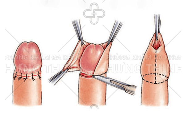 Hình ảnh quy trình phẫu thuật cắt bao quy đầu