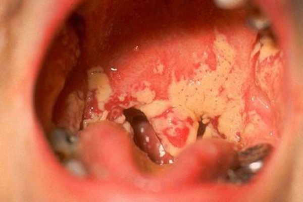Hình ảnh bệnh lậu ở miệng